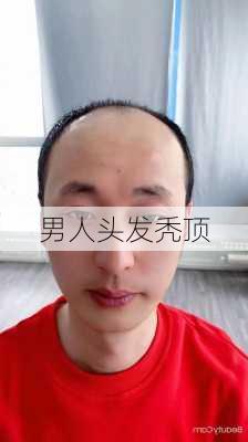 男人头发秃顶